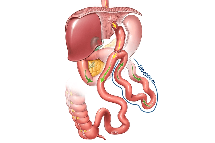 Bipartial Gastric Shunting