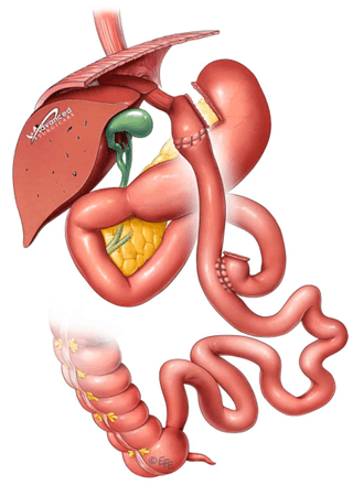 Gastric Bypass