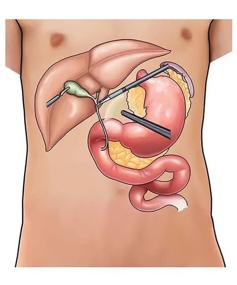 Laparoscopic