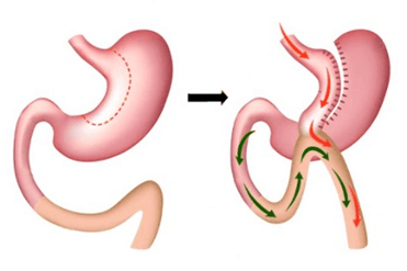 single-anastomotic-gastric-bypass