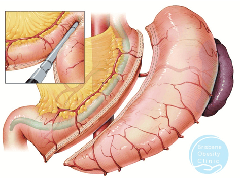 Vertical Resection Of The Stomach