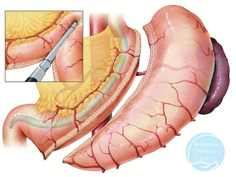 Vertical Resection Of The Stomach