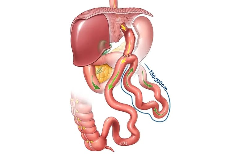 Bipartial Gastric Shunting