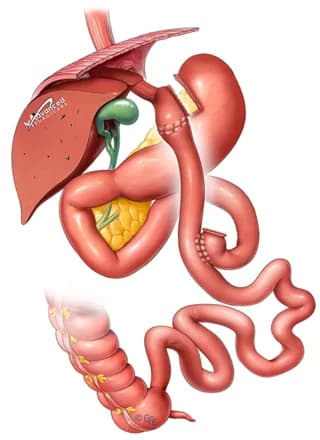 Gastric Bypass